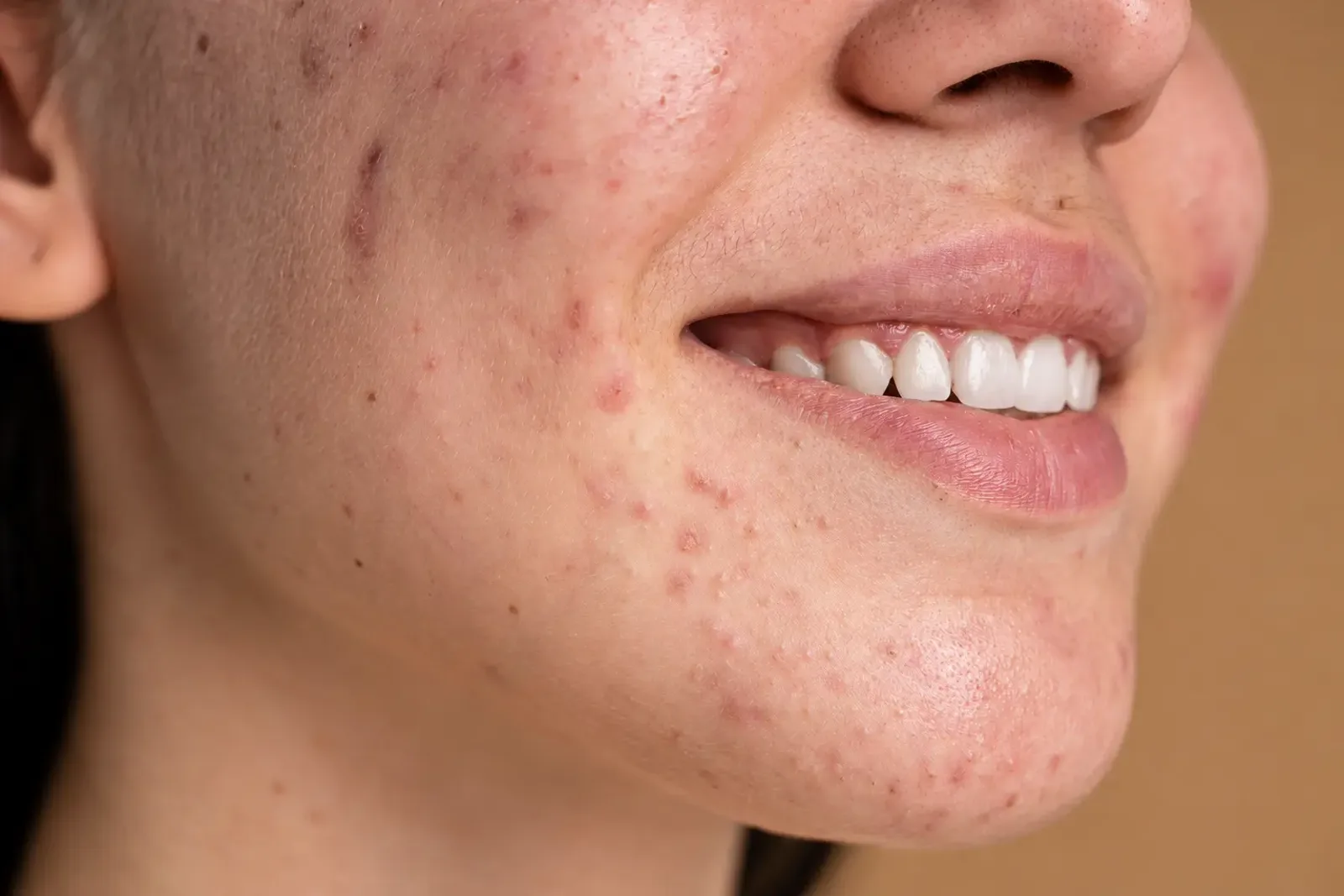 Close-up of acne and blemishes on a person's cheek and chin